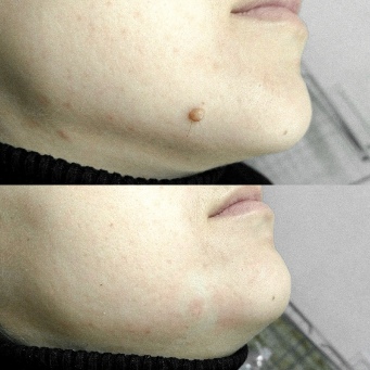 Before and after the use Skincell Pro