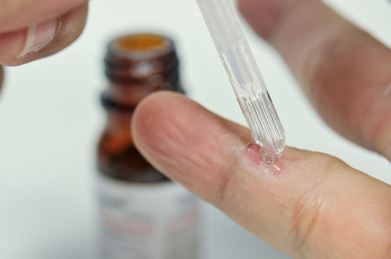 removing a wart on the finger with medicine