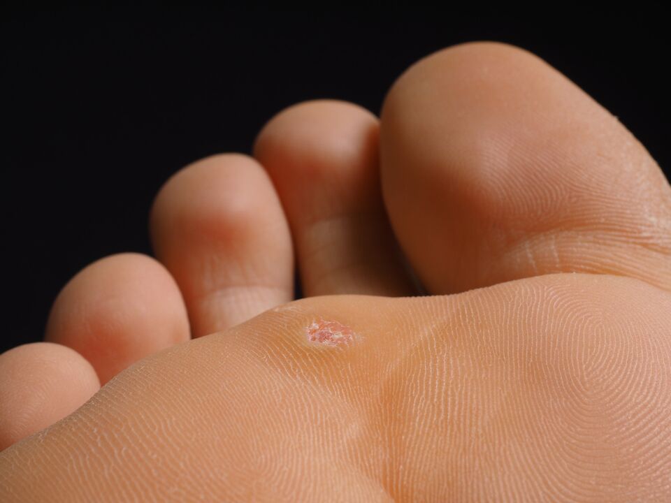 what does the plantar wart look like