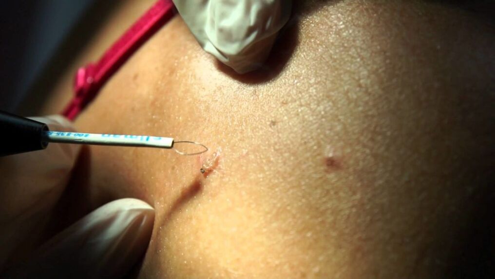 removal of the papilloma radio wave