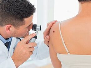 doctor examines the papilloma around recommends removal with medication