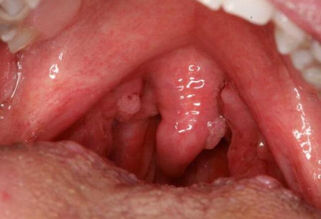 papilloma in the throat