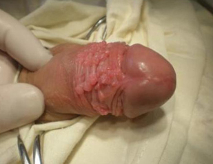Papilloma in the penis