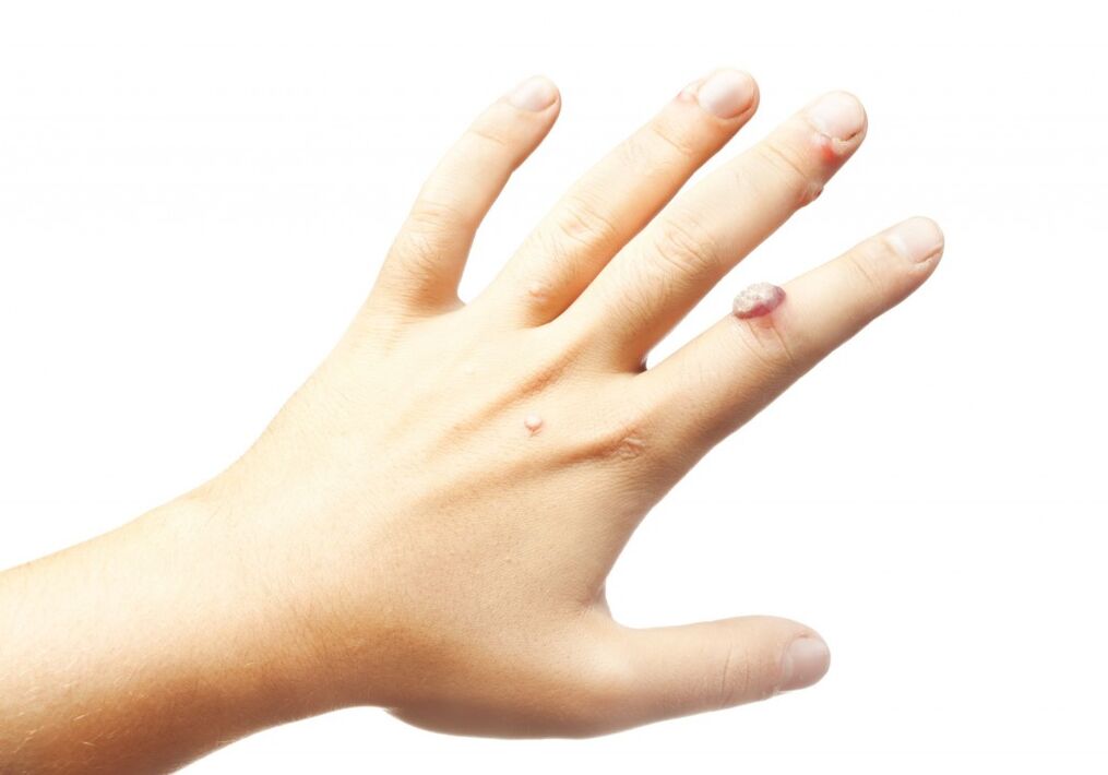 papilloma on the fingers