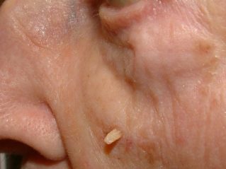 Displacement of warts